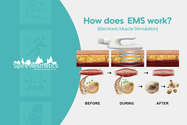 EMS treatment for post pregnancy weight loss treatment Chelmsford