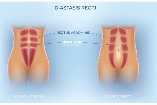 What Non-Surgical Options Are Available for Diastasis Recti Chelmsford?