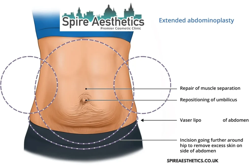 Understanding Loose Skin After Gastric Band Chelmsford Surgery and HIFU Treatment