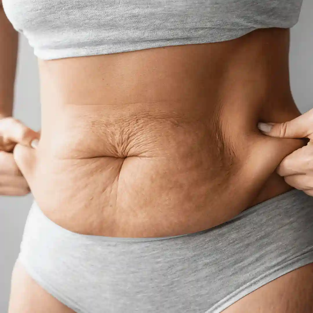 Is It Normal to Have Loose Skin After Pregnancy Chelmsford?