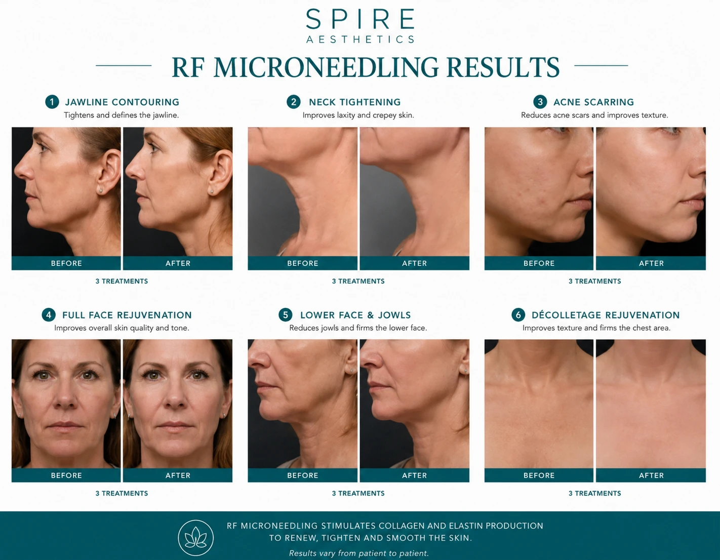 RF Microneedling Skin tightening Chelmsford results