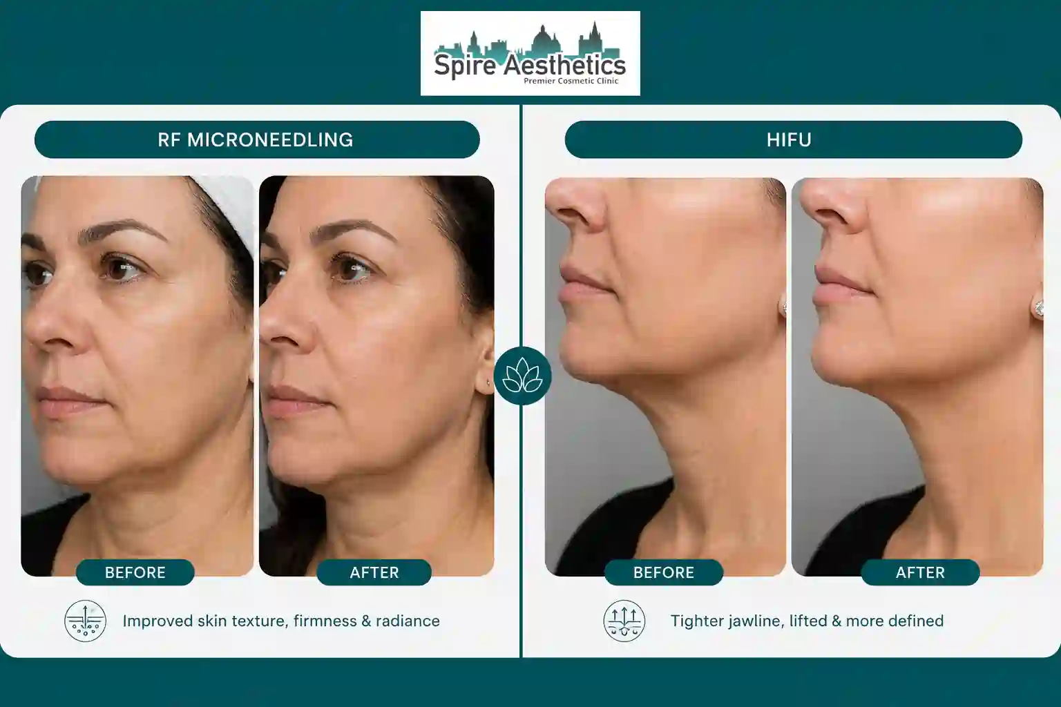 Can RF Microneedling and HIFU Be Combined Chelmsford?