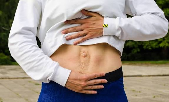 When Could Diastasis Recti Be the Missing Piece of the Puzzle Chelmsford?