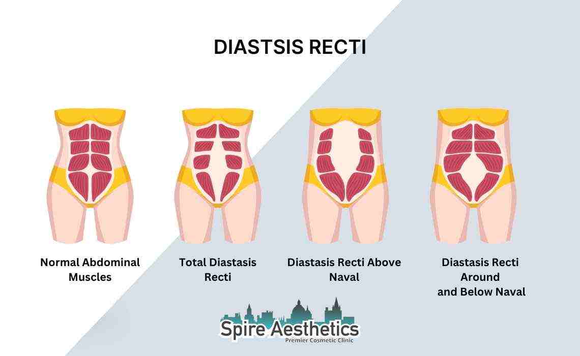 Is Non-Surgical Diastasis Recti Treatment Right for You? Common Concerns Answered Chelmsford